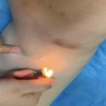 告别“缠腰龙”剧痛 铺棉灸让疼痛“一燃而愈”