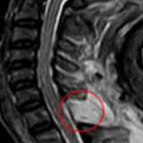 颈肩疼痛不一定是肩周炎，还要警惕这个疾病！