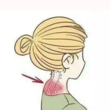 “富贵包”不是“富贵”，按摩能否按下去？