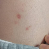 “不起眼”的小红点，竟是身体发出的危急警报！