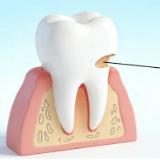 健康科普丨牙颈部的“小缺缺”是刷牙刷出来的吗？