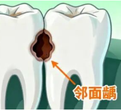 健康科普丨“一个洞为何补两颗牙？”揭秘牙齿邻面龋的真相
