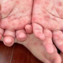 宝贝手心脚心冒小红疹?请看冬季手足口病防护指南