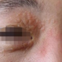 头部剧痛、眼长水疱？警惕眼部带状疱疹这个“视力杀手”