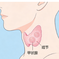 别慌！这种结节分级再高，也不一定是癌