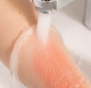 健康新“马”力 | 烧烫伤急救,这几点一定要记牢