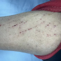 健康科普 | 肾病患者皮肤“痒痒痒”怎么办？