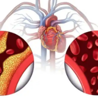心梗发病呈年轻化 胸部不适超15分钟需立即就医