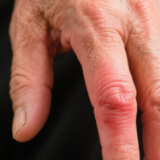 健康过大年 别让痛风“搅局”