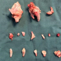 少女腹中惊现24颗牙齿，医生从她肚脐取出“畸胎瘤”