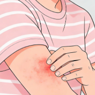 健康科普 | 反复发作、痒到睡不着?一文读懂湿疹怎么防、怎么治