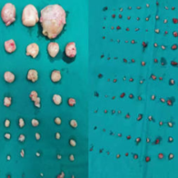 湖南省妇幼保健院妇三科完成两例高难度子宫肌瘤剔除术