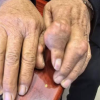 警惕！痛风不控食、不治疗，小心长出痛风石