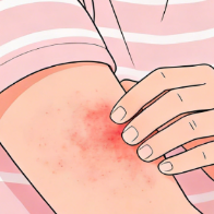 专家：荨麻疹≠过敏 服药切忌吃吃停停