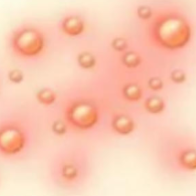 带状疱疹盯上年轻人，4招教你守护健康