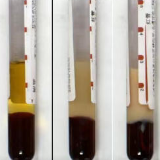 这个数值高，血液会变成“牛奶样”，急症风险激增！