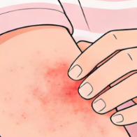什么是光敏性皮炎 该如何预防？一文了解