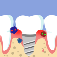 健康科普丨种植牙“发炎”了怎么办？这些风险和方法要牢记
