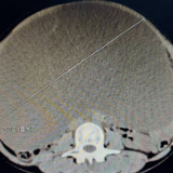 六旬女子肚子大如足月孕妇 手术抽出11000毫升囊液
