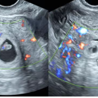 湖南省妇幼保健院精准诊断罕见“宫内外复合妊娠”