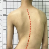 驼背会导致脊柱侧弯吗？专家解答