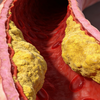 健康科普 | 你的血管还好吗？关于颈动脉斑块，你需要知道这些