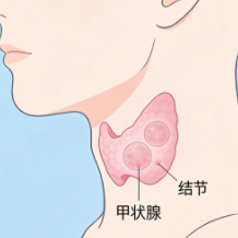 缺碘可能诱发甲状腺结节 这些要“碘”请牢记