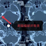 新化县人民医院顺利完成全县首例脑脊液耳漏修补+面神经松解减压术