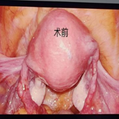 助圆母亲梦 双峰县首例腹腔镜下输卵管复通术成功施行