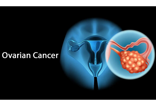 卵巢癌——易被忽视的“腹部炸弹”