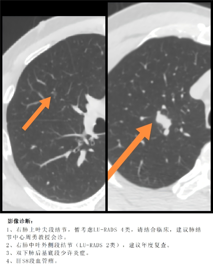 长沙泰和医院开启多发肺结节精准治疗新阶段
