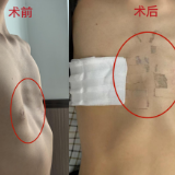 长沙泰和医院为两名14岁漏斗胸少年成功实施NUSS矫正手术