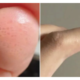 春末夏初高发的手足水疱实为汗疱疹 皮肤科专家提示避免搔抓与误用消毒水