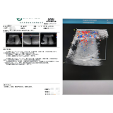 精索扭转360度!泰和医院泌尿外科团队成功为外地游客复位固定