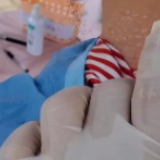 心疼！高温天里护士被晒伤脖子起泡