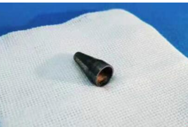 10岁男童替换笔芯，笔头“弹”进肺里