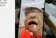 4岁女童疑遭继母殴打昏迷 “嘴唇都被剪掉了”