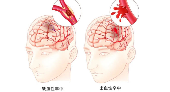  气温骤降 医院急诊脑卒中患者增多