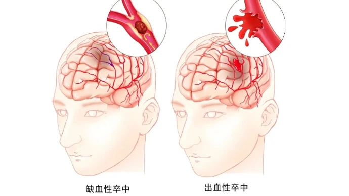  氣溫驟降 醫(yī)院急診腦卒中患者增多