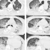 冬天也能“中暑”?警惕“冬季热射病”