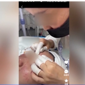 每周质量报告丨“针清”后痘痘不减反增 这些祛痘法操作不当可能会“烂脸”