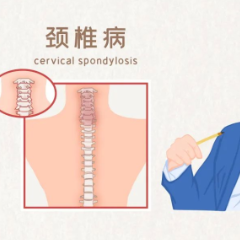 四种类型颈椎病，哪一种最不好惹 | 科普时间