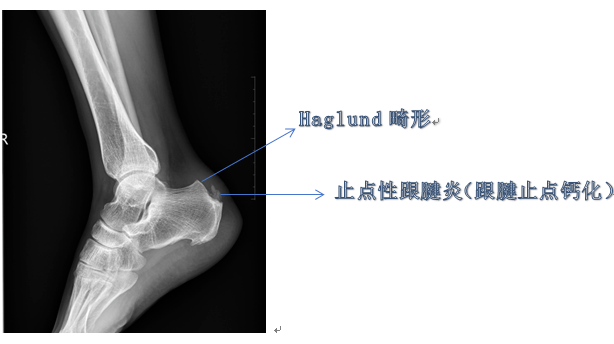 一男子脚跟疼，竟被医生告知“钙化”