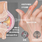 株洲市中医伤科医院：类风湿关节炎早发现早治疗 延缓损伤