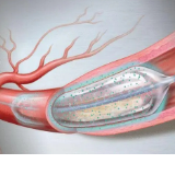 3月1日起 株洲一类冠脉药物涂层球囊价格由3万多降至6千余元