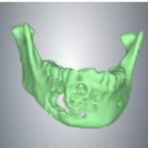 株洲市中心医院：3D打印脸部假体为患者恢复面容