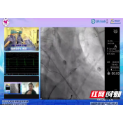 株洲市中心医院开展房颤“一站式”手术 为患者解后顾之忧