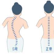 健康科普丨青少年脊柱侧弯 需要注意这些情况