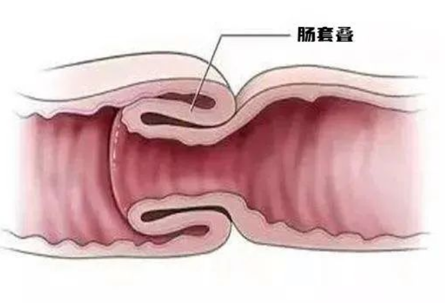 健康科普丨儿童哭闹不止、大便带血 需警惕肠套叠