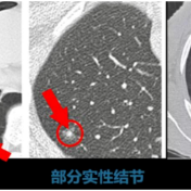 健康科普丨肺结节莫惊慌，单孔微创来化解